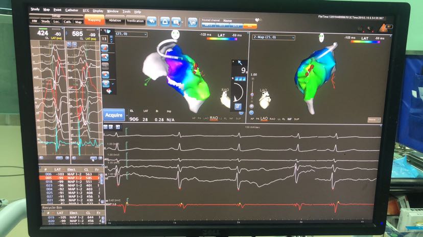 室性早搏治疗不止只有药物，这种方法更有效