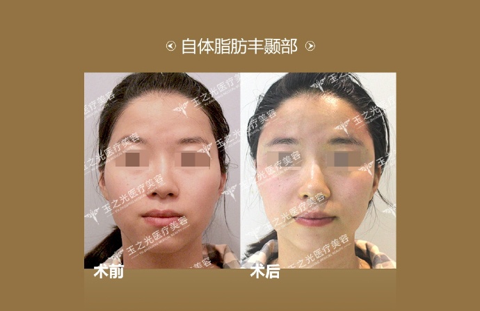 北京自体脂肪丰太阳穴对比图.jpg