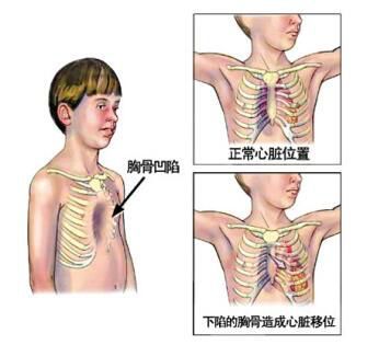 婴儿胸口正常图图片