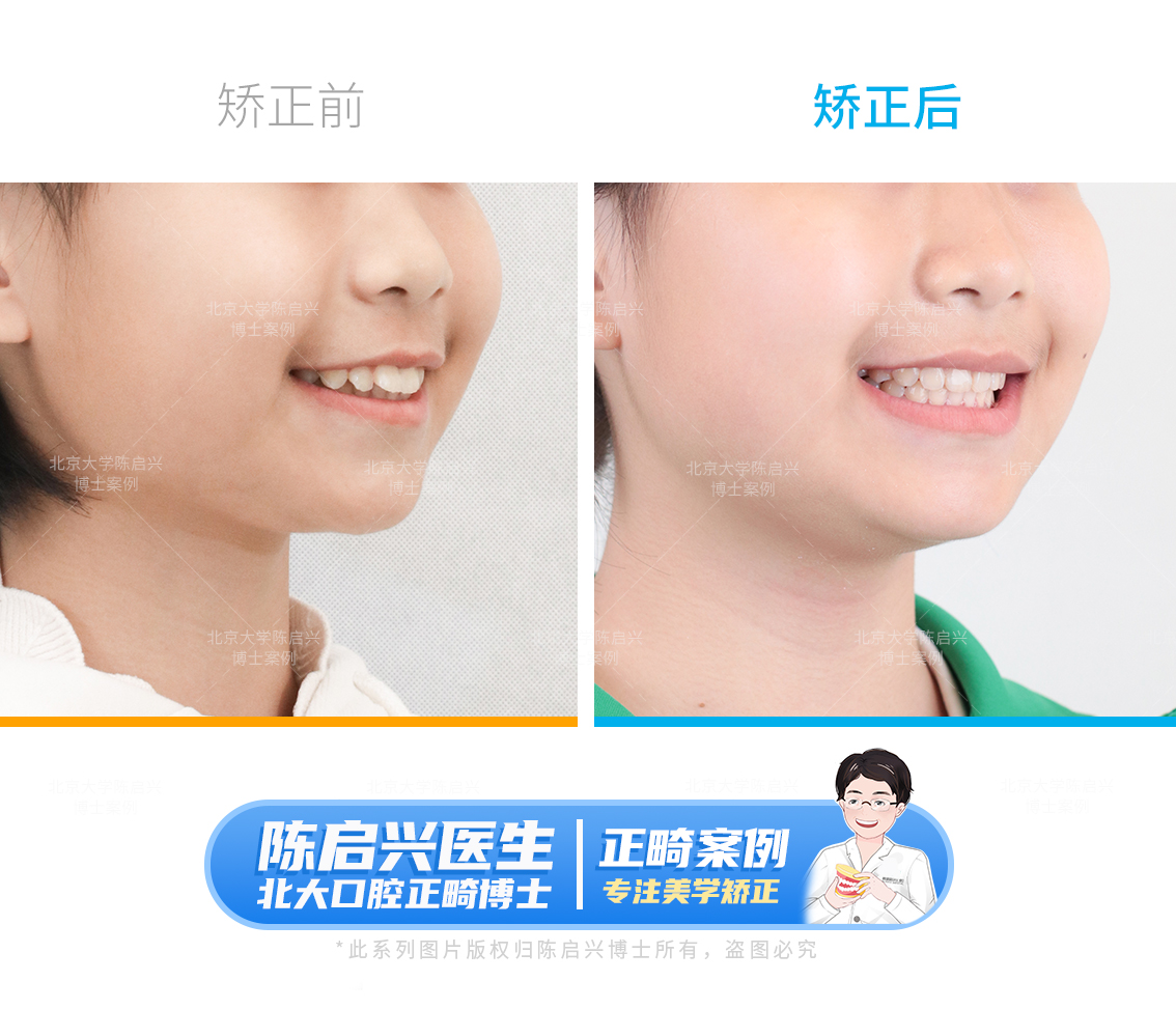嘴突+门牙外飘+牙齿拥挤不齐+下巴后缩_陈启兴_副主任医师_爱问健康