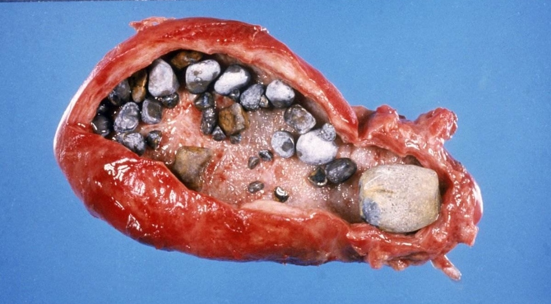 关于胆结石的那些事-胆结石是如何形成的?