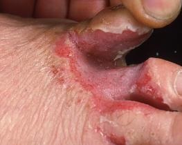 tineaPedisAthletesFoot_6401_lg.jpg