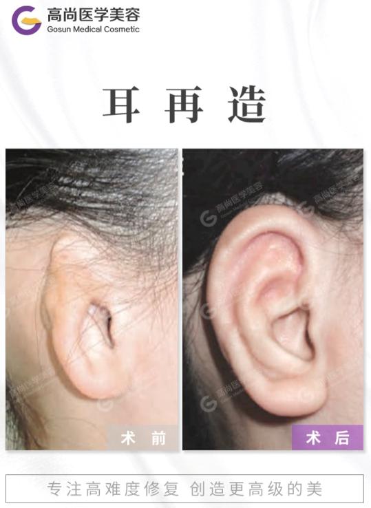 【先天性耳朵畸形图片】出现小耳畸形可通过耳再造手术治疗