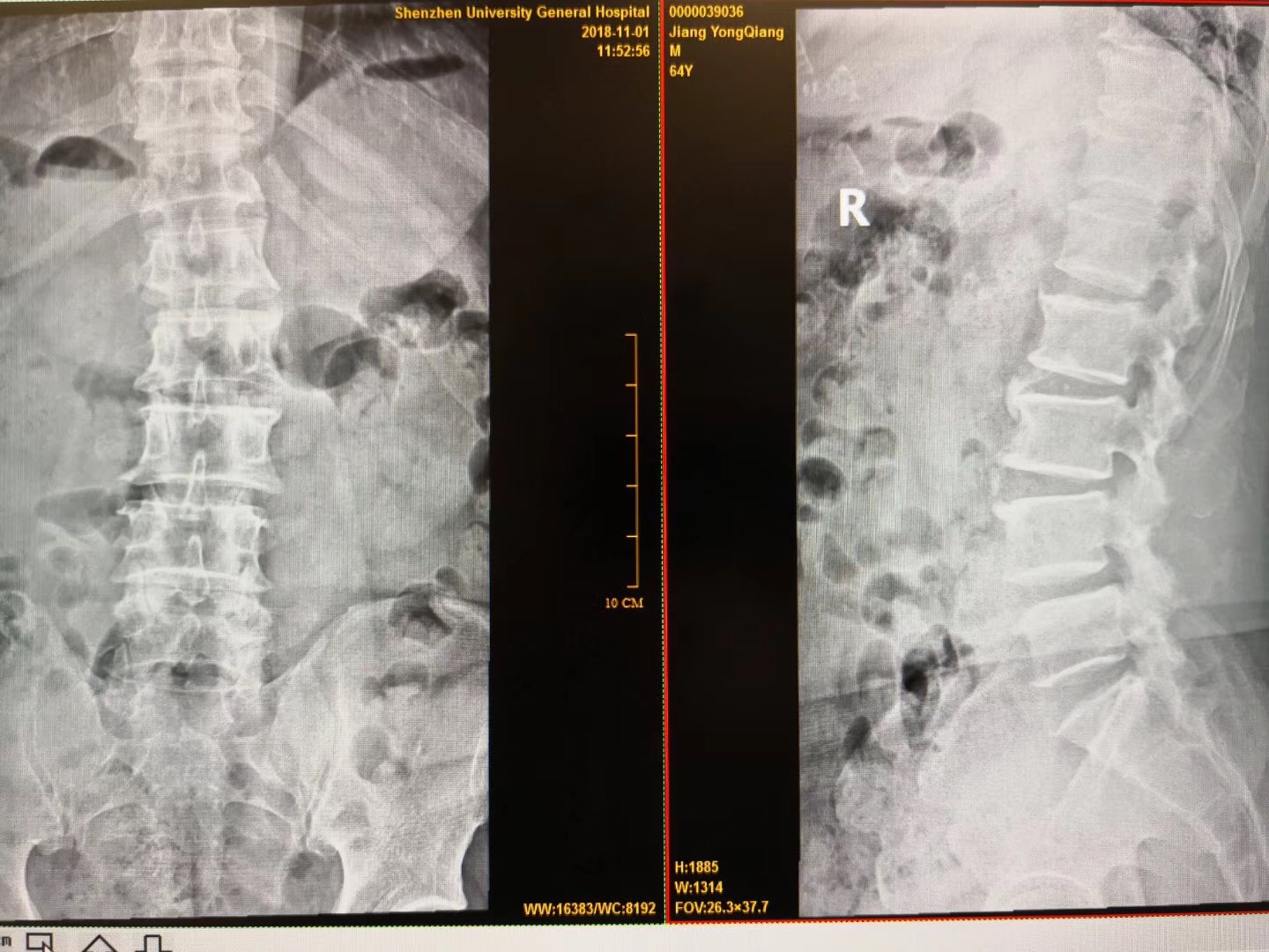 病例分析腰椎管狭窄症l34l45节段手术治疗