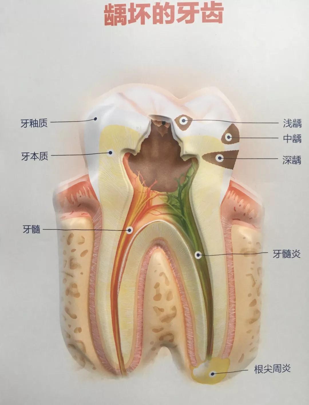 龋病是口腔主要的常见病,也是人类最普遍的疾病之一,世界卫生组织已将