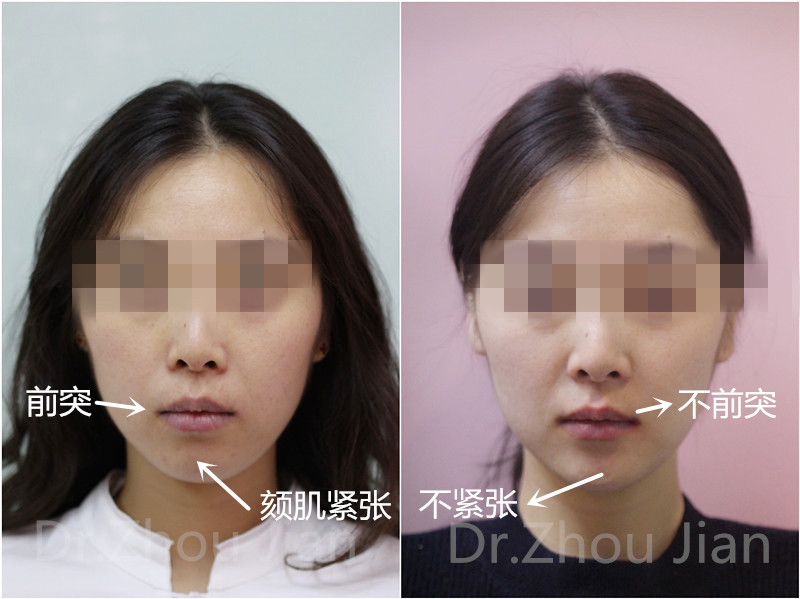 好莱坞的牙齿为何更吸引人?