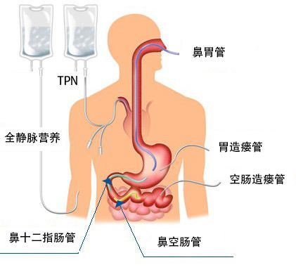 下胃管进行鼻饲。如果出现严重的低蛋白血症，还是需要静脉补充白蛋白。