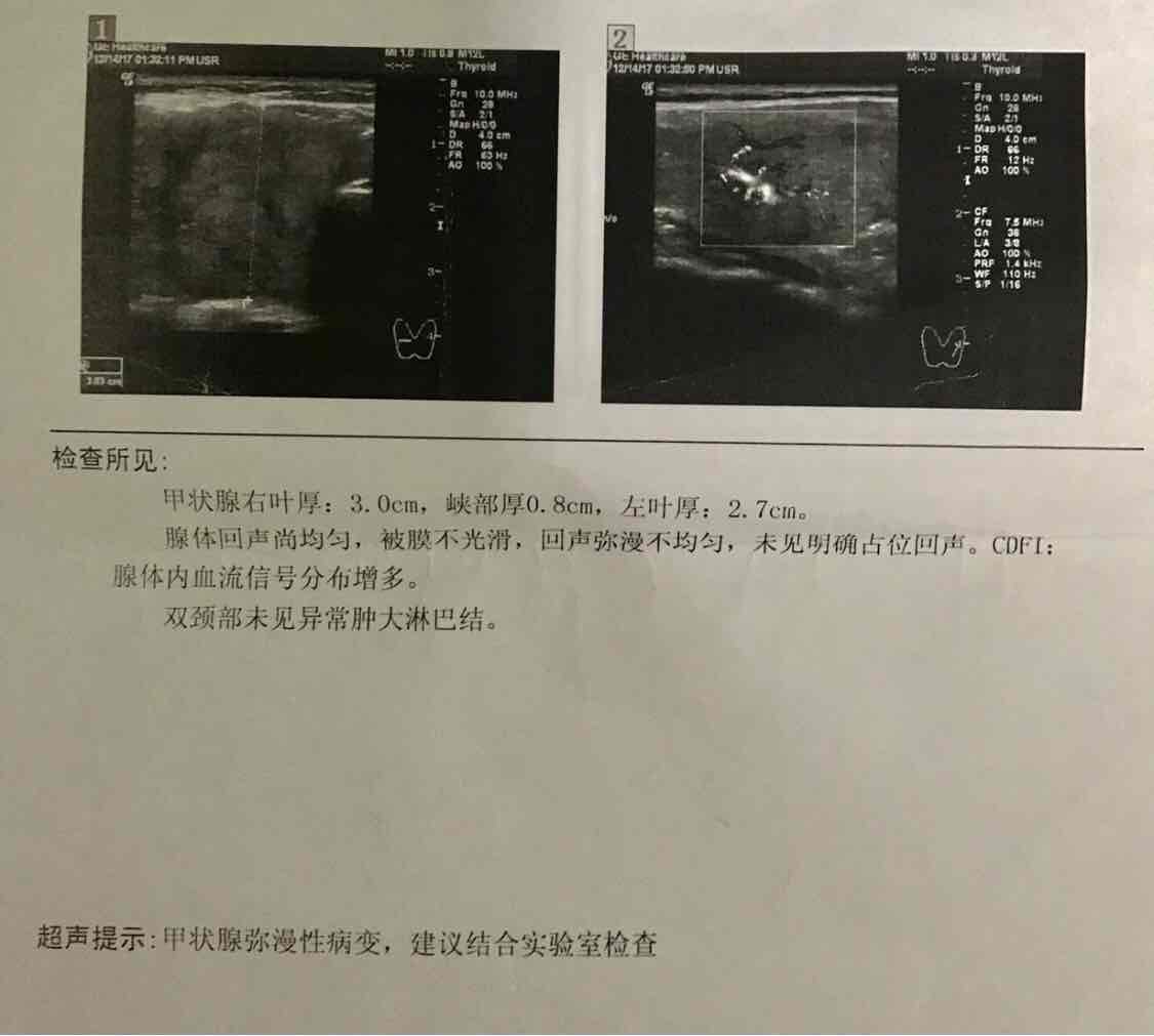 桥本氏甲状腺炎到底是一种什么样的病?