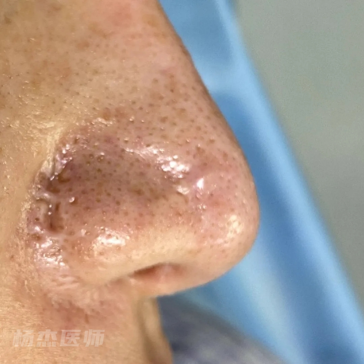 伤口周围起痘,伤口周围感染 ;形成原因:二,增生型鼻翼疤痕4,伤口缝合