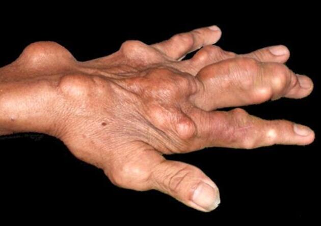 苏打水能治痛风吗?