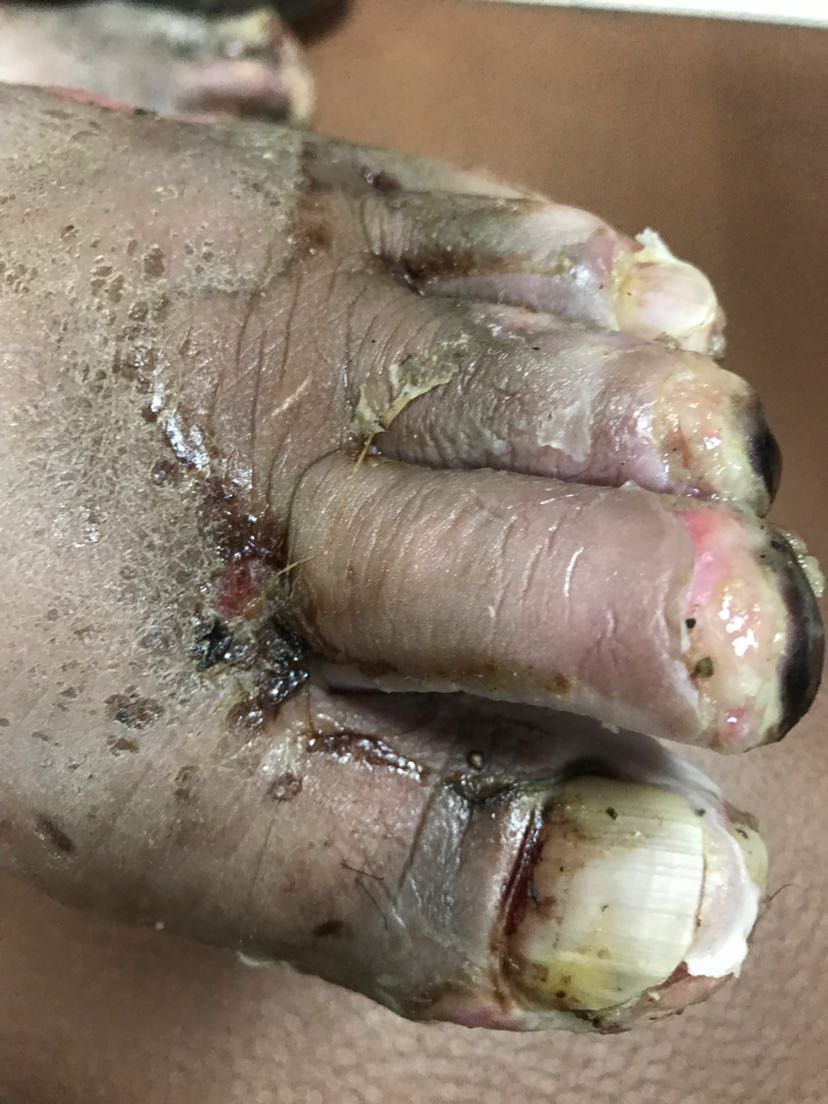 主要致病真菌是红色毛癣菌,絮状