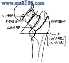 股骨颈骨折的分型.jpg