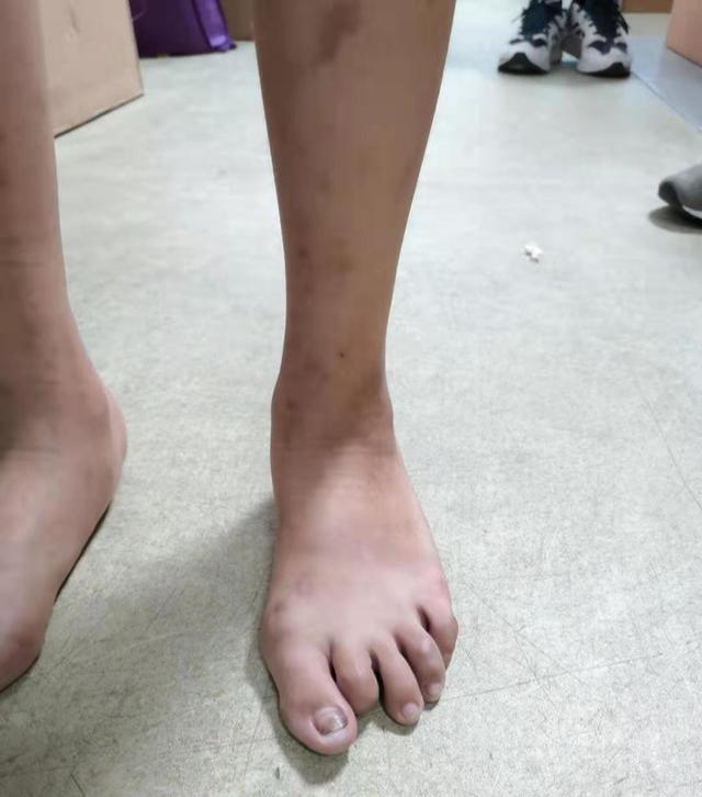 八字脚是不是脚内翻,影响跑步吗?应该怎么矫正呢?