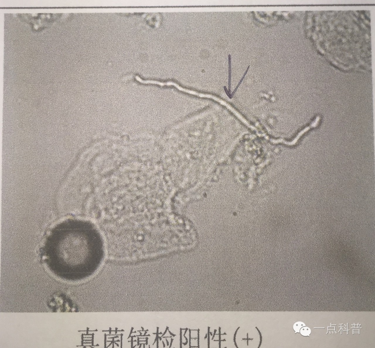 显微镜下的真菌脚气图片