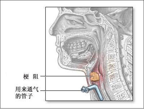 家属担心的“割喉”叫气管切开，医生提醒：8类人要做，并不危险_曲晶东_副主任医师_爱问健康