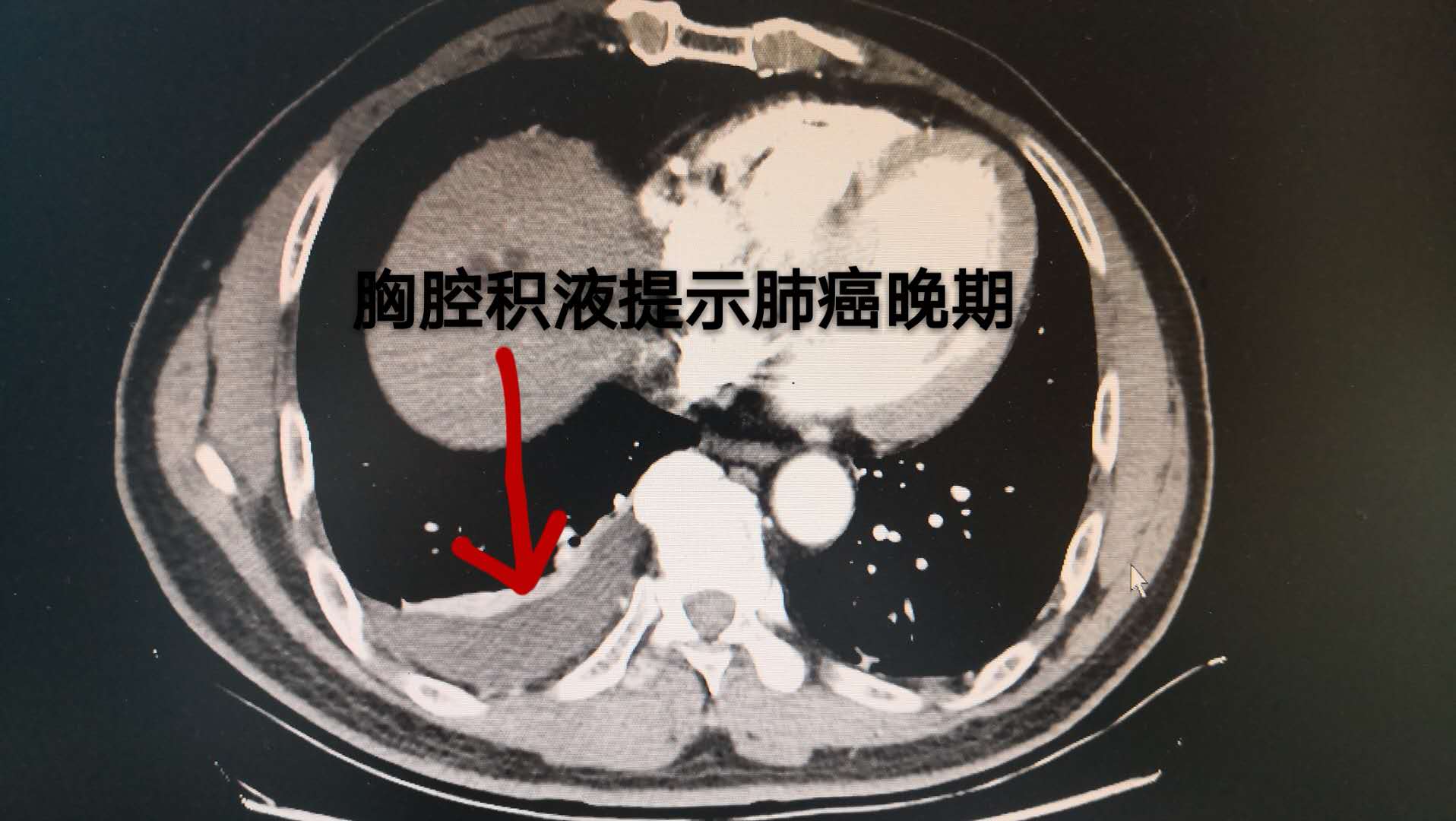 肺癌晚期肺积水图片图片