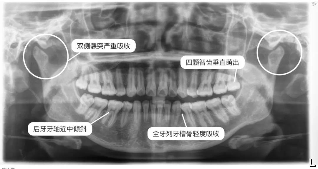 你还看不懂X光片?徐医生带你全面解析_徐巍娜_主任医师_爱问健康