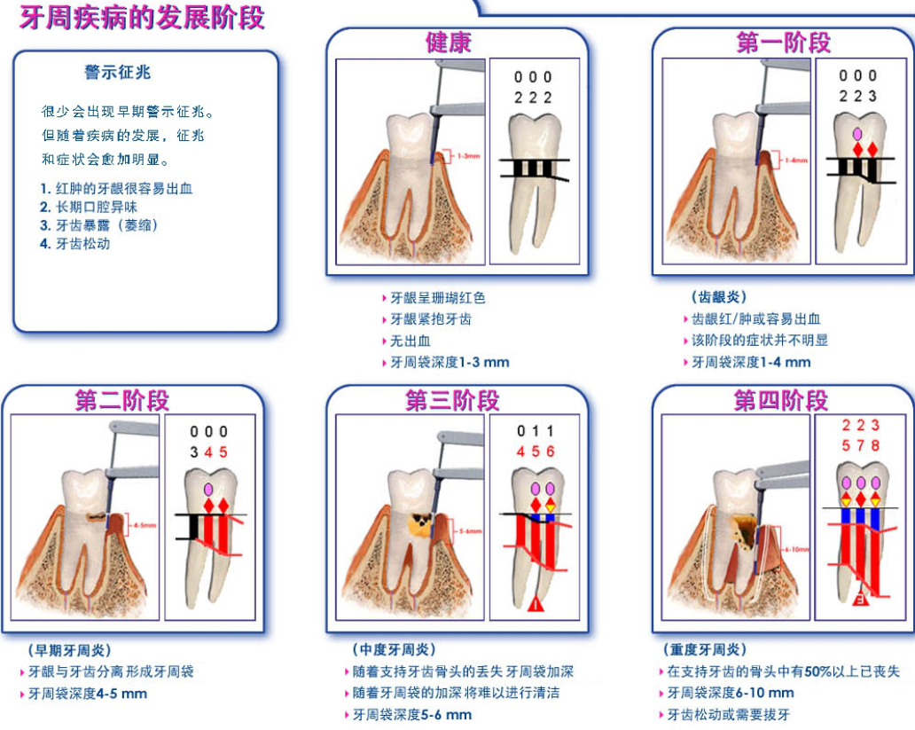 牙周袋自己如何看图片