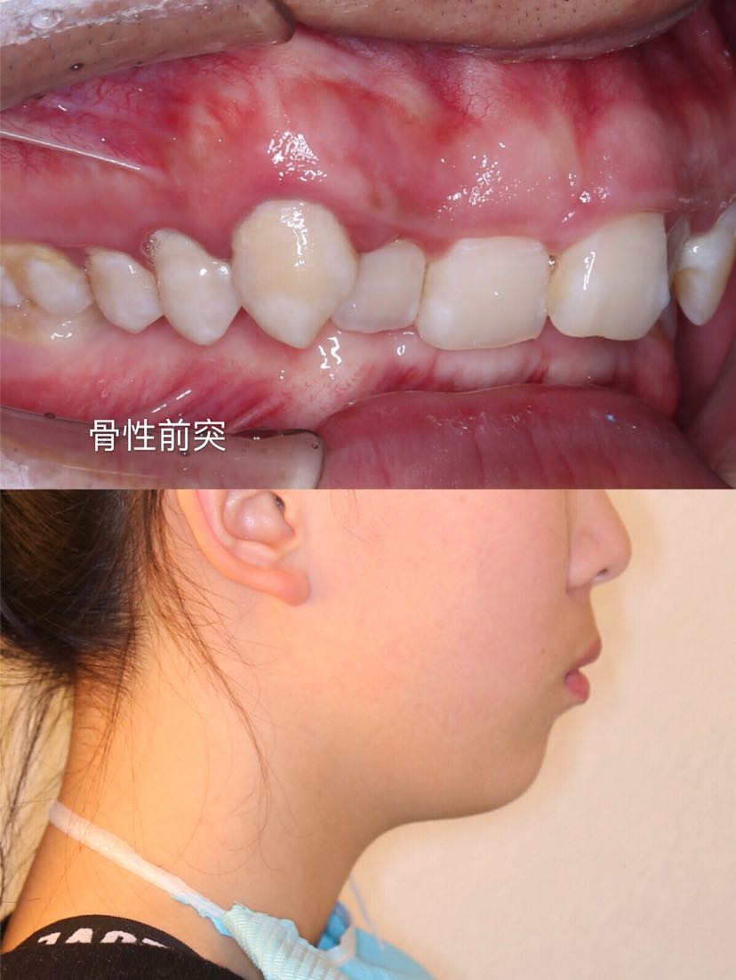 也就是牙性前突的患者上颌骨是不突的,因此"牙性"前突中上前牙往前