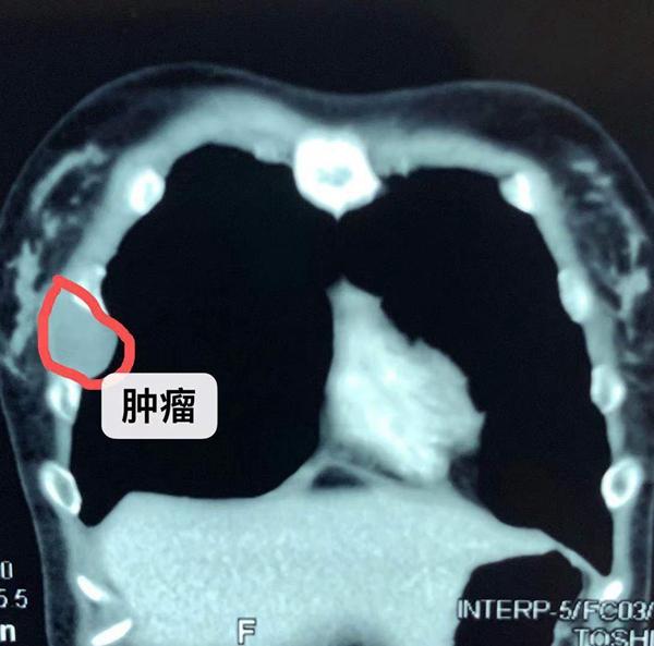 肋骨肿瘤恶性的图片图片