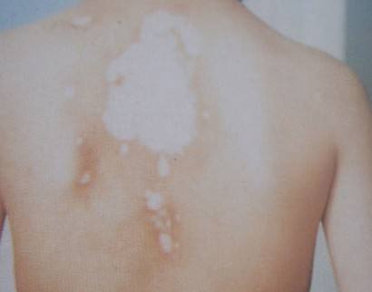 什么是窄谱紫外线治疗皮肤科普：窄谱中波紫外线使用须知_https://www.jmylbn.com_新闻资讯_第1张