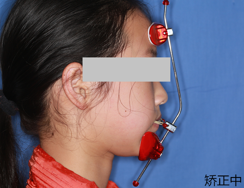 牙齿矫正面部牵引器图片