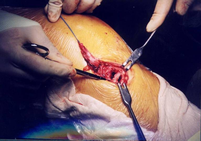 有关内侧副韧带(mcl)一些小知识