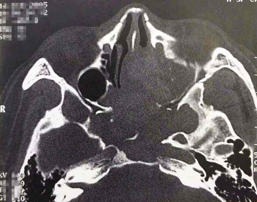 图文解说：鼻窦真菌感染的CT诊断_张旭戈_副主任医师_爱问健康