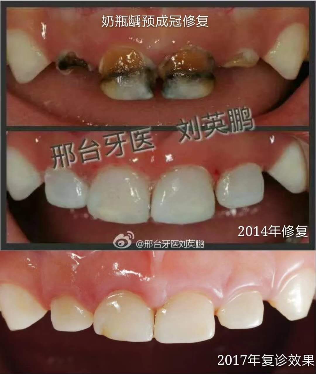 详解婴幼儿奶瓶龋,怎么治疗?