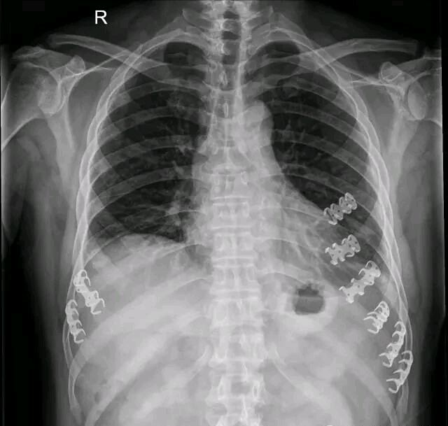 正视肋骨骨折内固定术