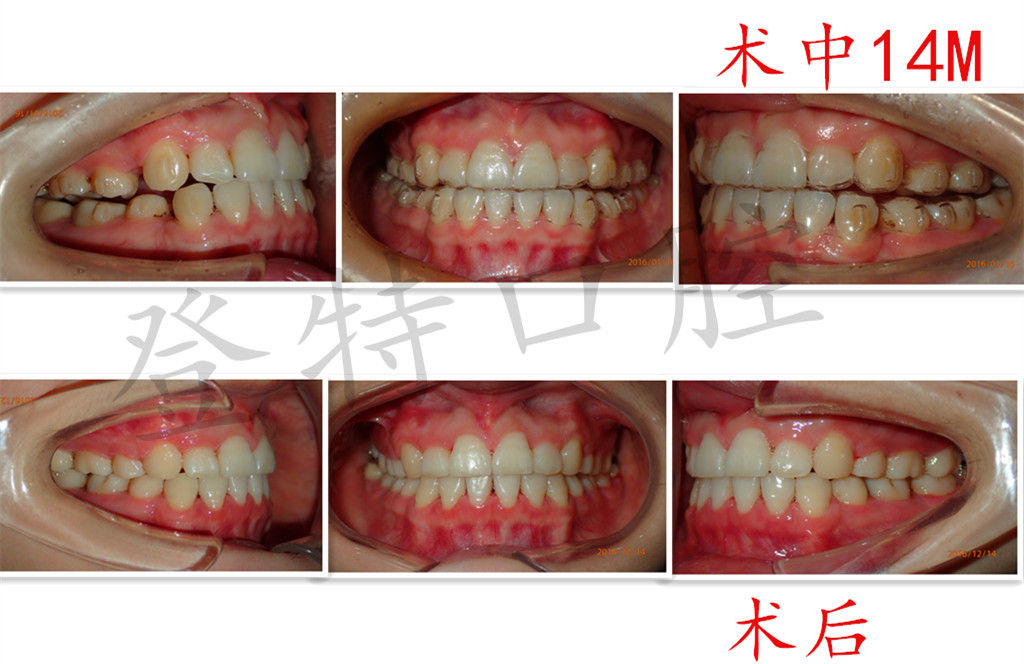 矫治结果:排齐上下牙列,恢复美观的牙弓弧形,恢复正常咬合关系有其他
