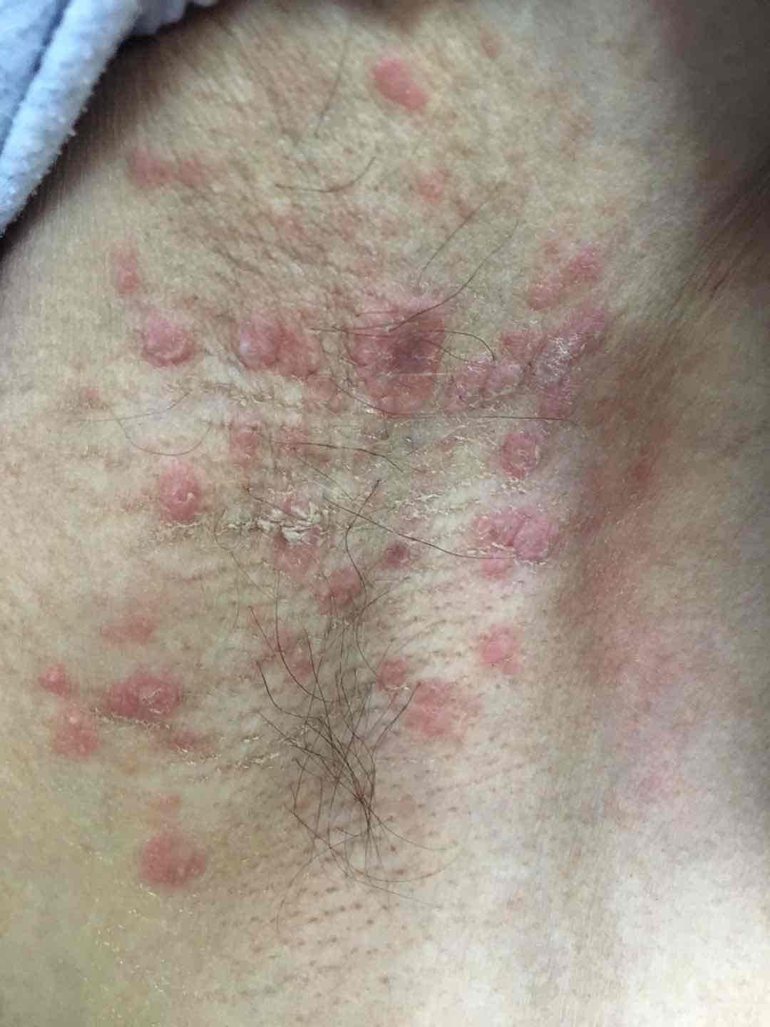 梅毒疹出现部位皮肤图片
