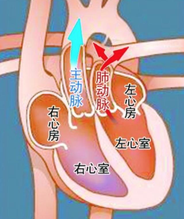 大动脉转位解剖图图片