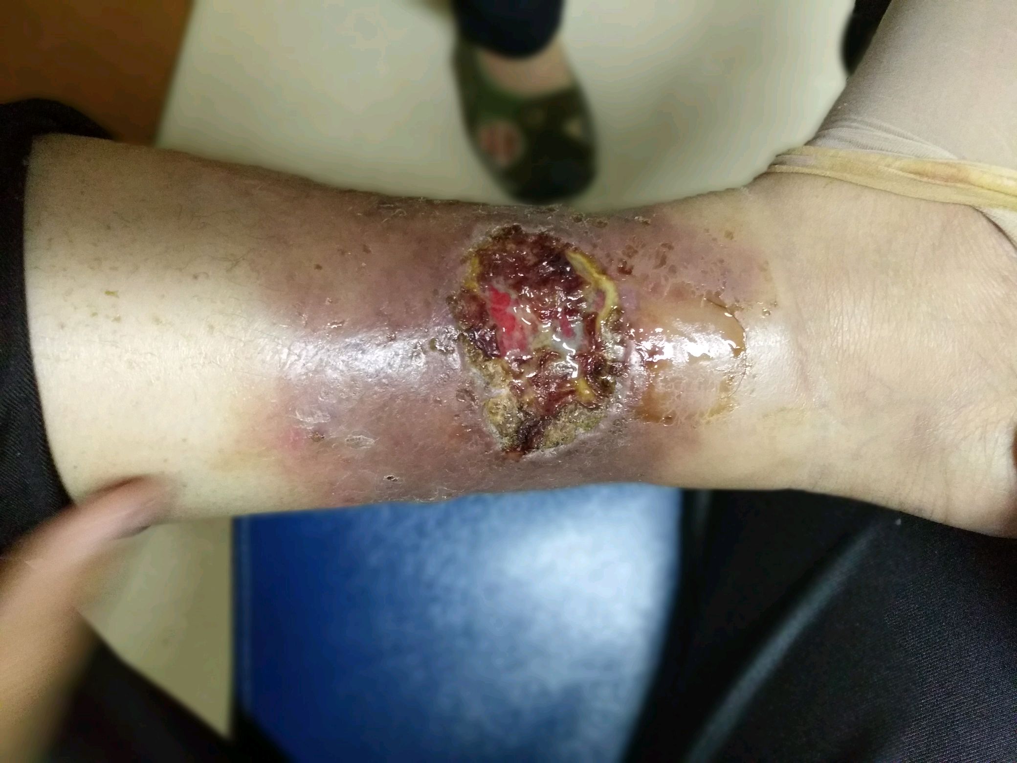 小腿溃疡的思考