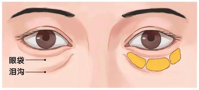 泪沟究竟应该如何治疗?_吴冬梅_主任医师_爱问健康