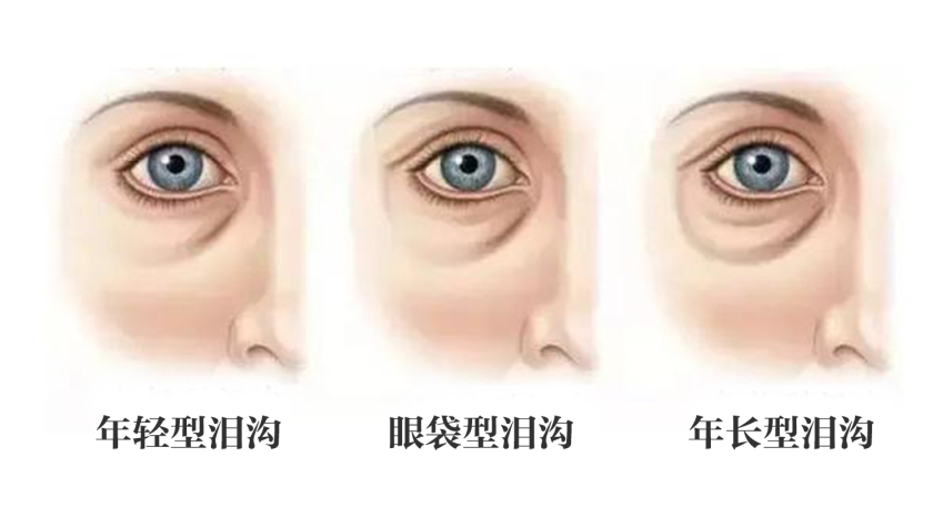 泪沟究竟应该如何治疗?_吴冬梅_主任医师_爱问健康