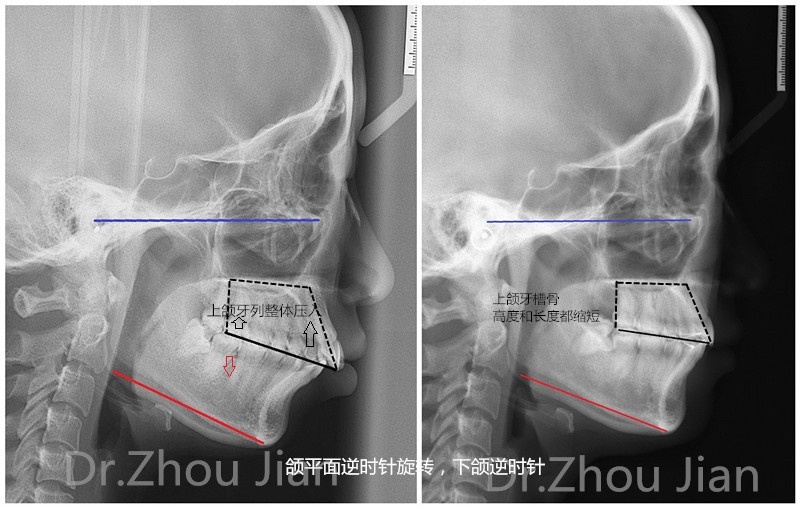 不用削骨正畸就可以让你的颜值走向巅峰