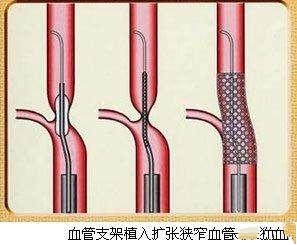 血管支架过程示意图图片