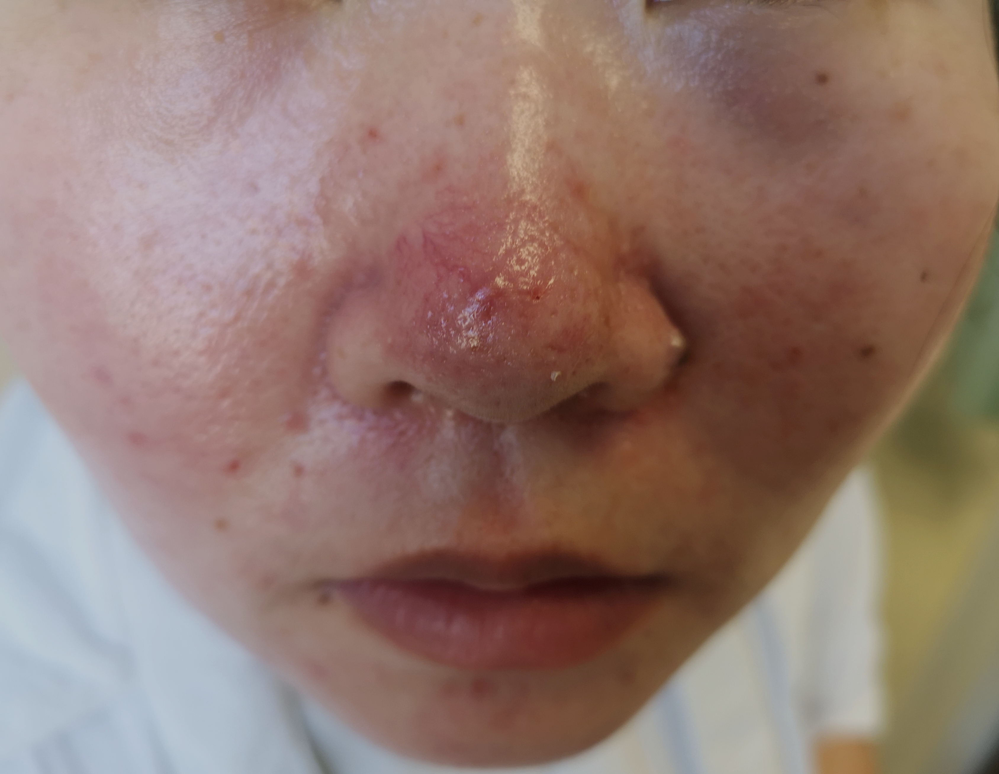 玫瑰痤疮,寻常痤疮和酒渣鼻,傻傻分不清!