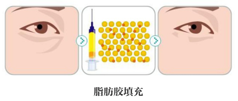 泪沟究竟应该如何治疗?_吴冬梅_主任医师_爱问健康