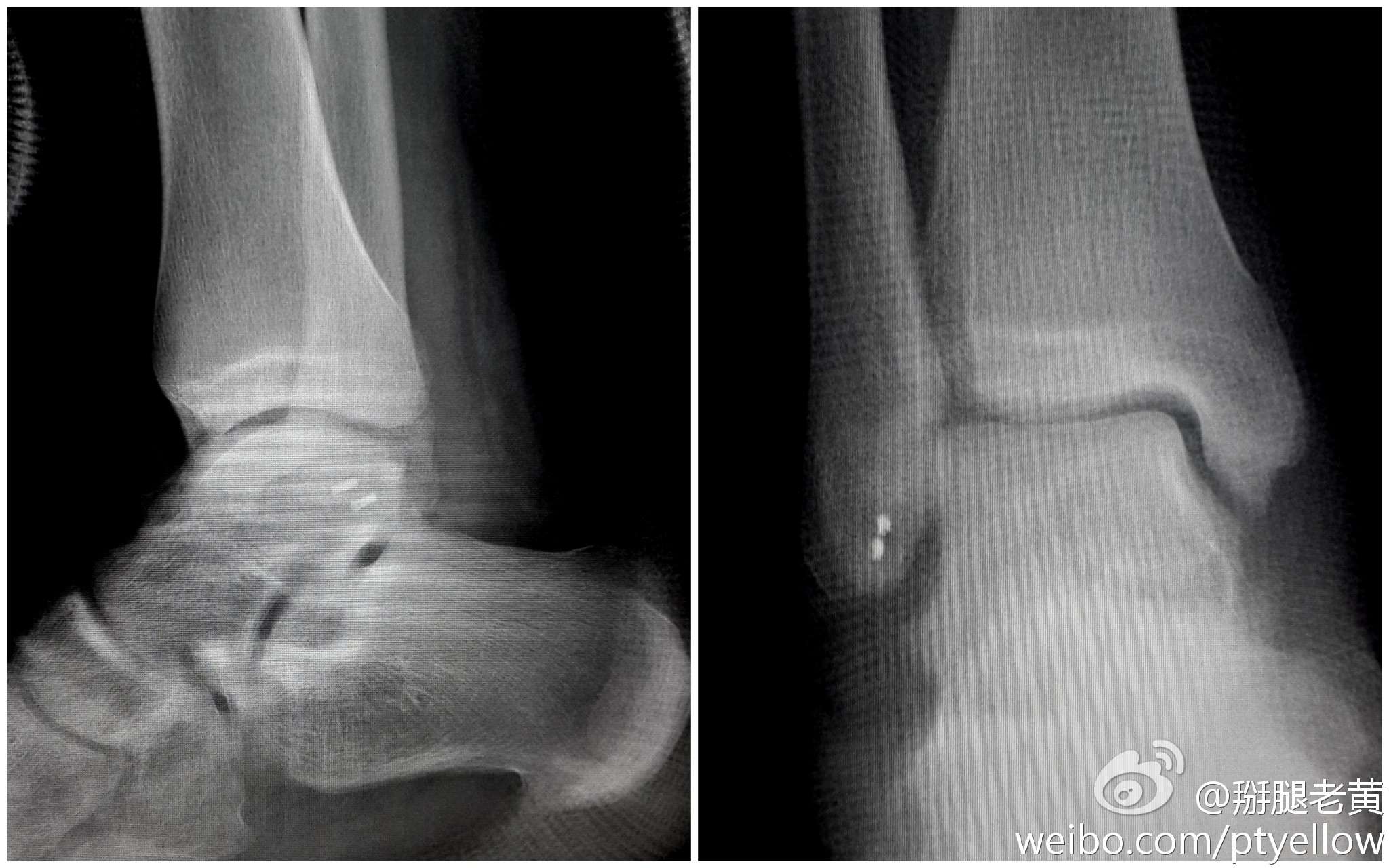 外踝韧带损伤简述