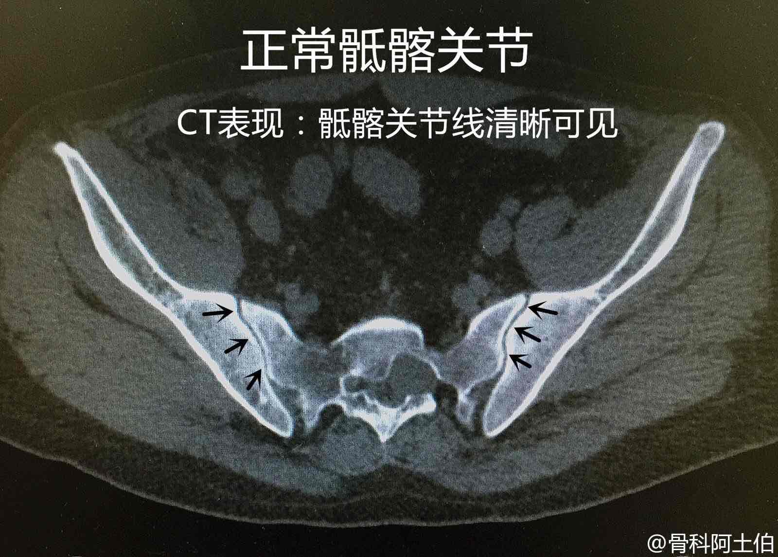 骶髂关节磁共振正常图图片