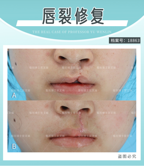 兔唇嘴巴缺了一块,说话漏风?这样修复效果很理想!_余文林_副主任医师_爱问健康