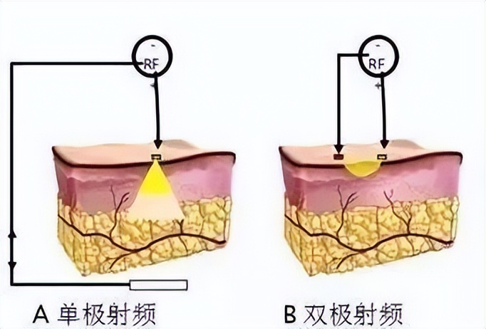 双极射频是什么3.微针射频因为被包装成“黄金微针”而被大家熟知。通过有形的针精准定位于真皮深部或浅部，除了释放的射频能量起作用，针刺本身的机械刺激也会促进胶原新生，启动损伤修复机制。在通道打开同时搭配一些靠谱的功效成分，可以相得益彰。除了促进年轻化，还可以治疗痘坑、腋臭和妊娠纹等，因为射频的“色盲”特点，相比点阵_https://www.jmylbn.com_新闻资讯_第4张