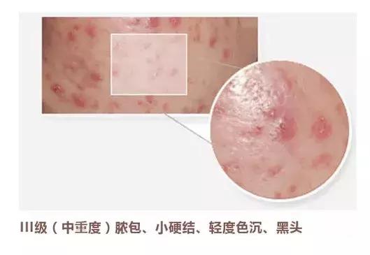 探索银屑病治疗的最新进展