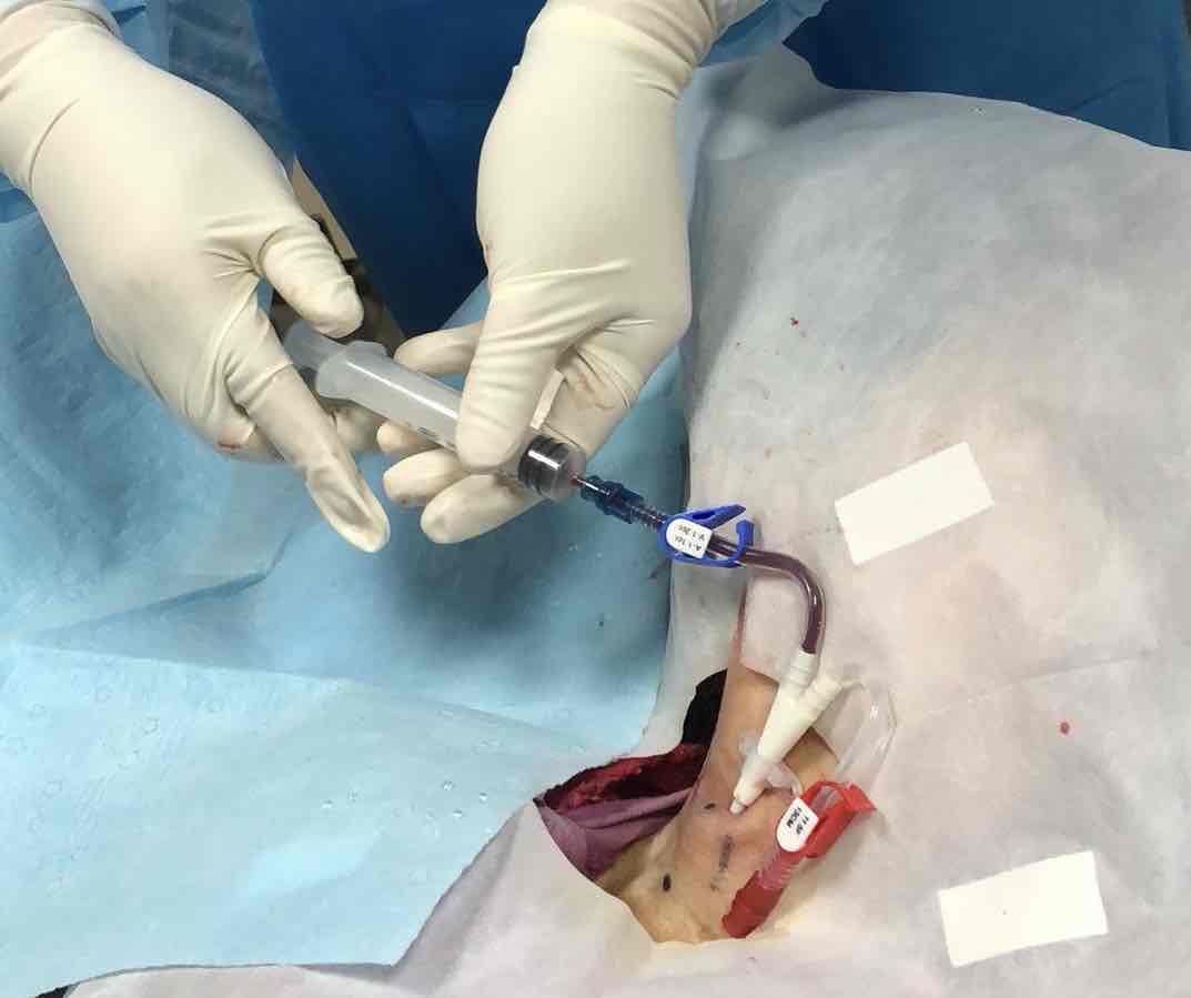 深静脉置管(透析用)