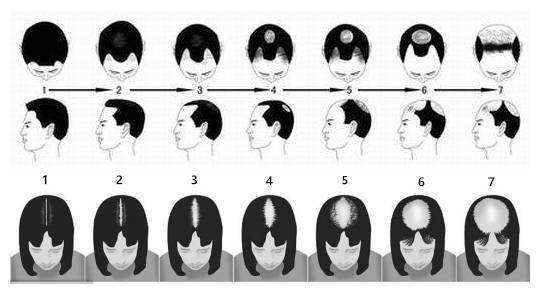 只是男性遗传的几率高于女性几倍遗传脱发基因不单单和男性遗传有关