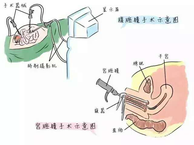 腹腔镜手术通常是要在腹部打几个孔来进行操作,宫腔镜手术则是通过