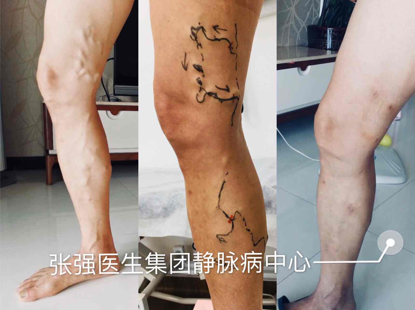 6月份的父亲节,我也会在成都的静脉病中心门诊,进行静脉曲张的免费