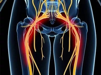 女性坐骨神经痛臀部疼图片